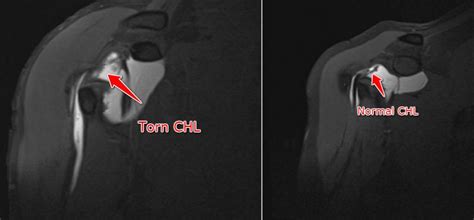 slap lesion rotator interval